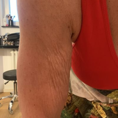 Refit Arme vor Behandlung