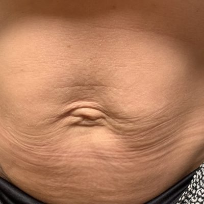 Bauch vor Refit Behandlung