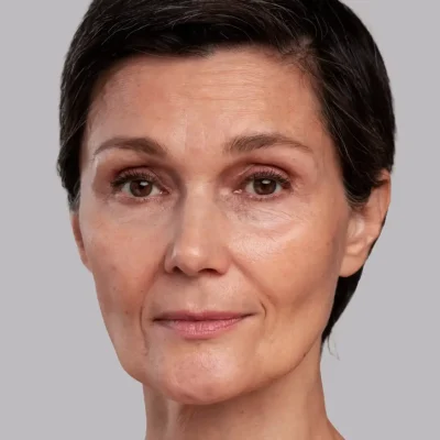 RF Microneedling Mönchengladbach Jennifer Eichholz by medbeauties