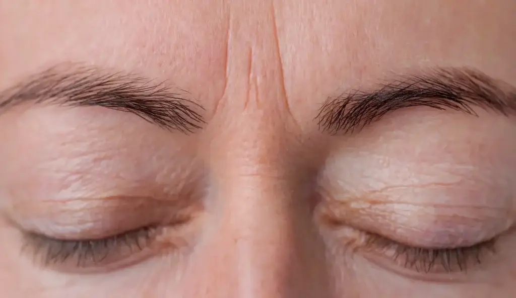 RF Microneedling GENTLO Jennifer Eichholz Mönchengladbach